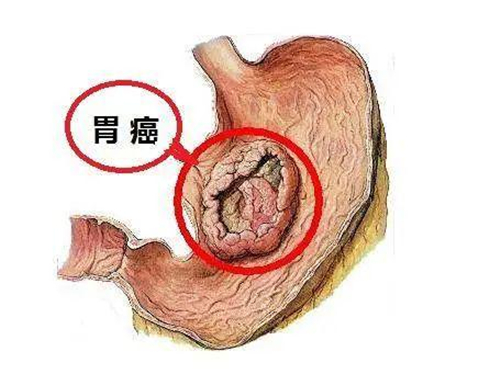 胃癌早期有什么症状